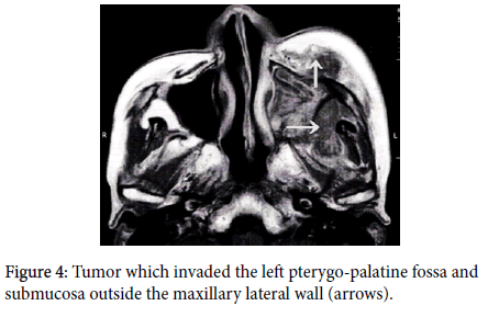 otology-rhinology-lateral-wall