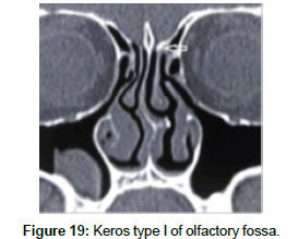otology-rhinology-olfactory-fossa