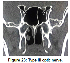 otology-rhinology-optic-nerve