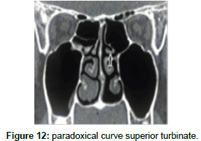 otology-rhinology-paradoxical-curve