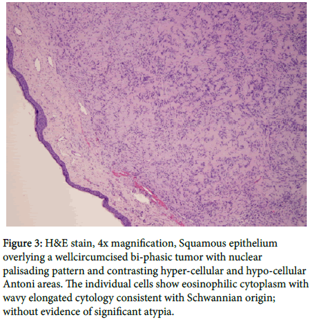 otology-rhinology-phasic-tumor