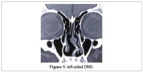 otology-rhinology-sided-DNS