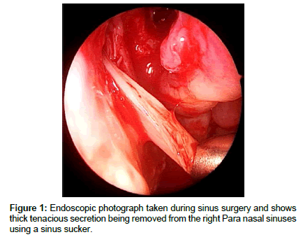 otology-rhinology-sinus-sucker