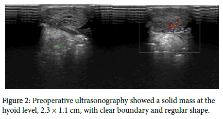 otology-rhinology-solid-mass