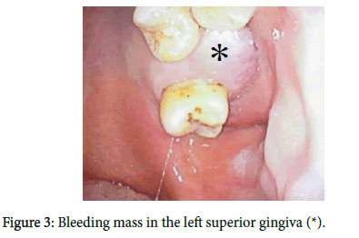 otology-rhinology-superior-gingiva