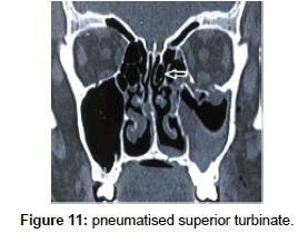 otology-rhinology-superior-turbinate