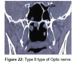 otology-rhinology-type-nerve