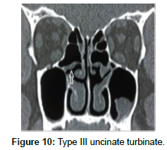 otology-rhinology-uncinate-turbinate