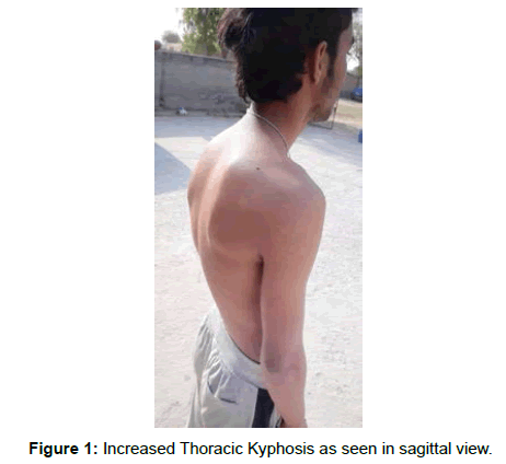 physiotherapy-rehabilitation-Thoracic-Kyphosis