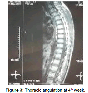 physiotherapy-rehabilitation-Thoracic-angulation