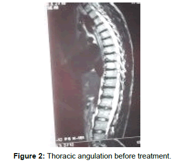 physiotherapy-rehabilitation-Thoracic-angulation-treatment