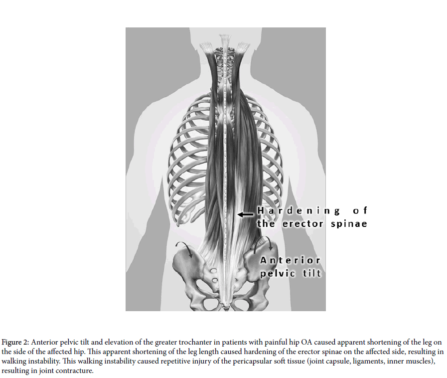 physiotherapy-rehabilitation-greater-trochanter