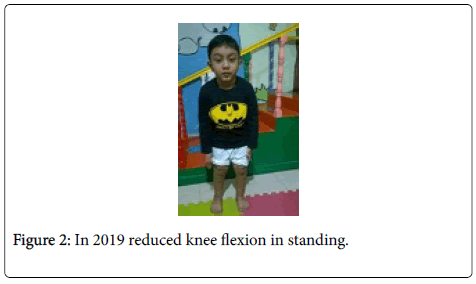 physiotherapy-rehabilitation-reduced-knee