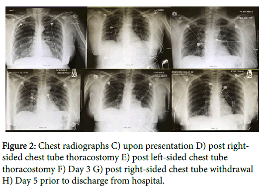 pulmonary-medicine-tube-thoracostomy