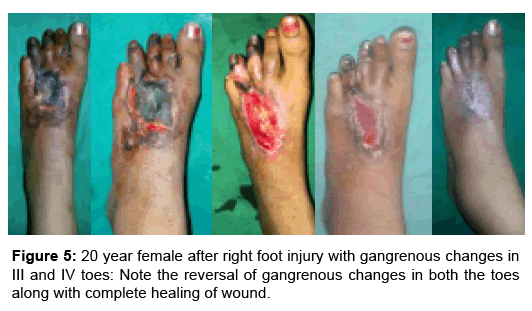 regenerative-medicine-foot-injury