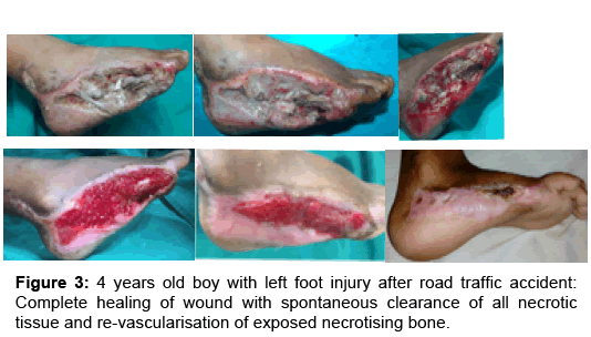 regenerative-medicine-necrotising-bone