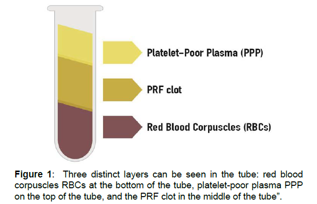 regenerative-medicine-platelet-poor-plasma