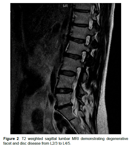 regenerative-medicine-sagittal-lumbar regenerative-medicine-sagittal-lumbar