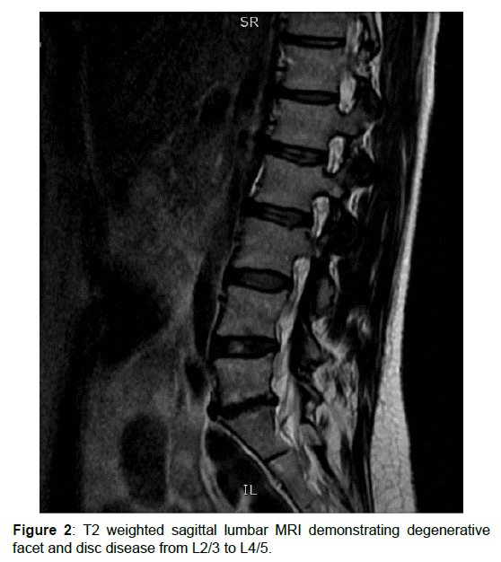 regenerative-medicine-sagittal-lumbar