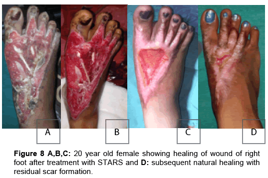 regenerative-medicine-scar-formation