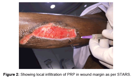 regenerative-medicine-wound-margin