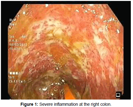 reports-gastroenterology-Severe-inflammation