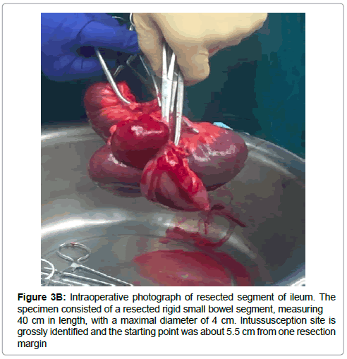 reports-gastroenterology-bowel-segment