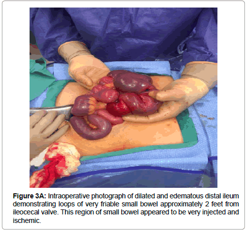 reports-gastroenterology-friable-bowel