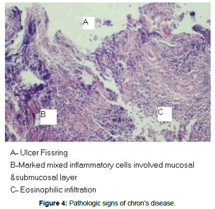 reports-gastroenterology-ulcer-fissring