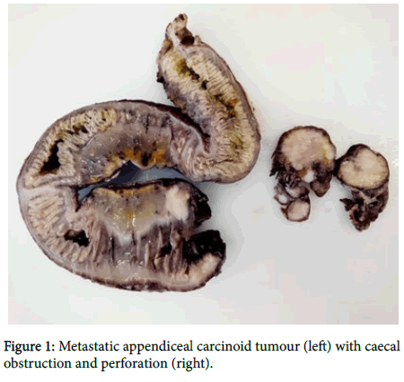 research-reports-gastroenterology-Metastatic