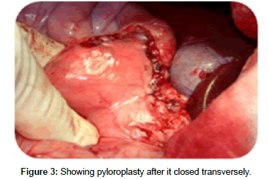 research-reports-gastroenterology-Showing-pyloroplasty