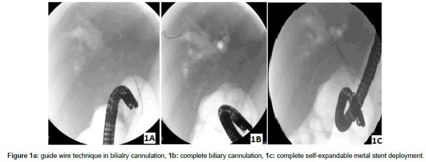 research-reports-gastroenterology-guide-wire