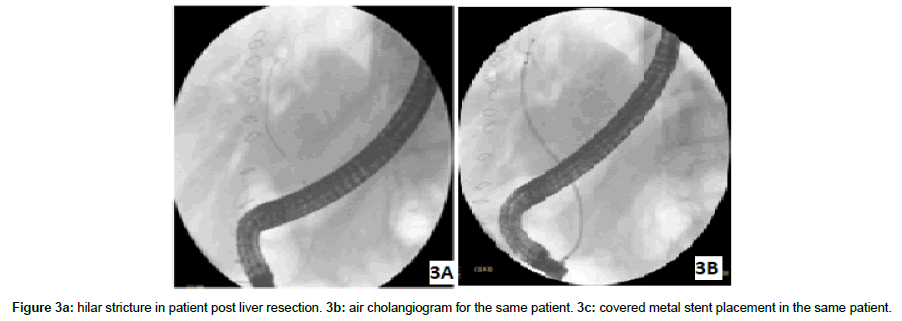 research-reports-gastroenterology-hilar-stricture
