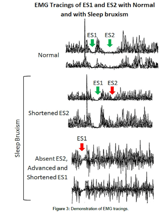 sleep-disorders-treatment-EMG-tracings