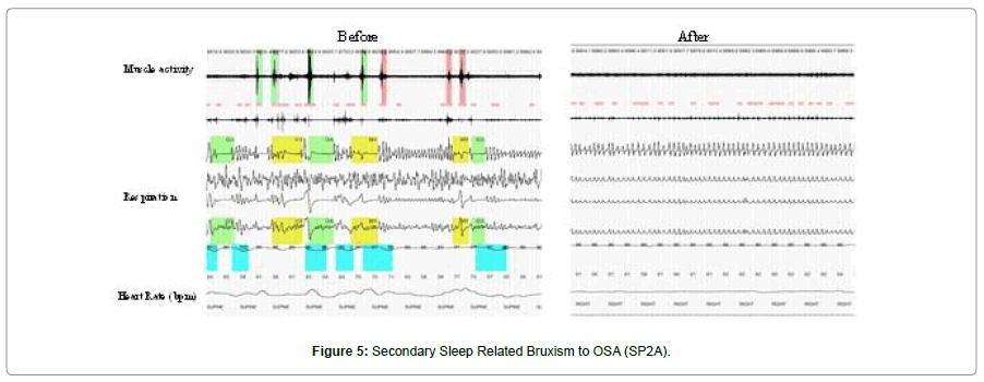 sleep-disorders-treatment-care-Secondary-Sleep