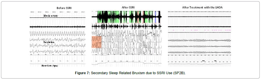 sleep-disorders-treatment-care-Sleep-Related-Bruxism