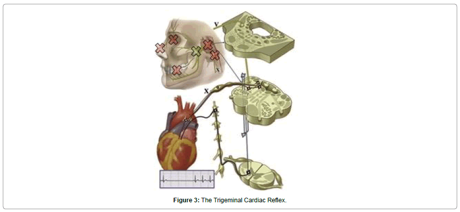 sleep-disorders-treatment-care-Trigeminal-Cardiac