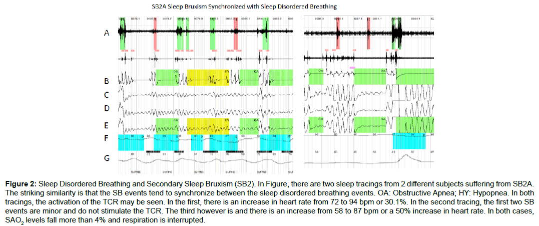 sleep-disorders-treatment-sleep-tracings