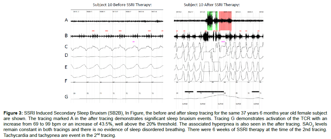 sleep-disorders-treatment-tracing-demonstrates