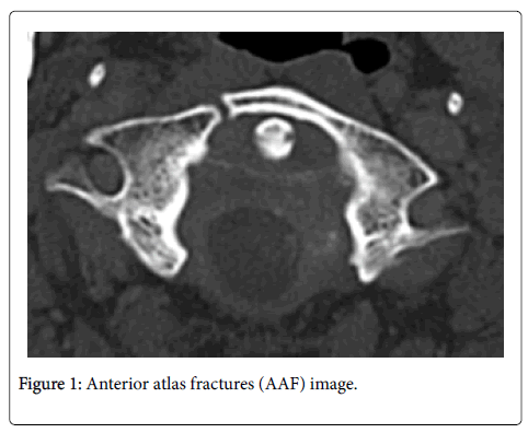 spine-neurosurgery-Anterior-atlas