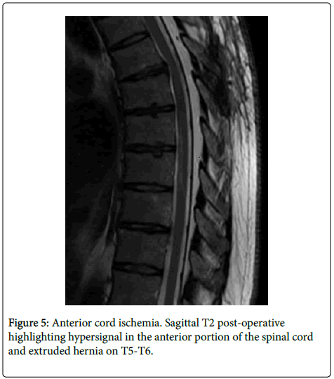 spine-neurosurgery-Anterior-cord