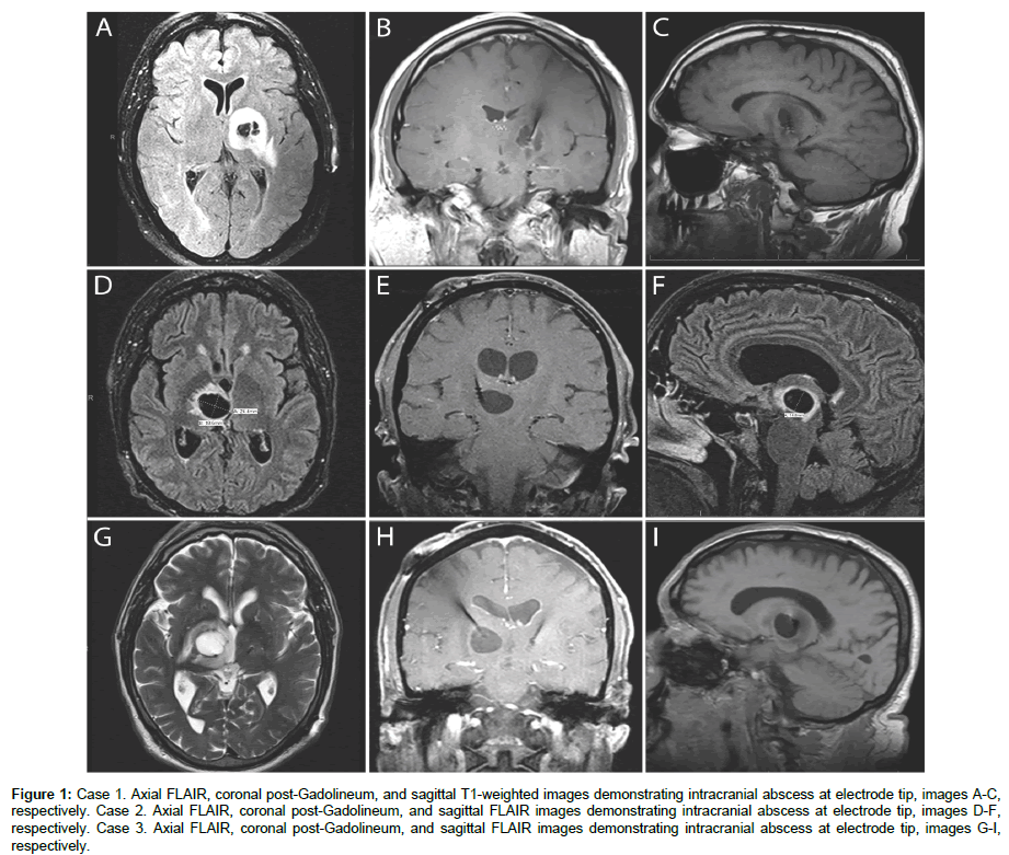 spine-neurosurgery-Axial-FLAIR