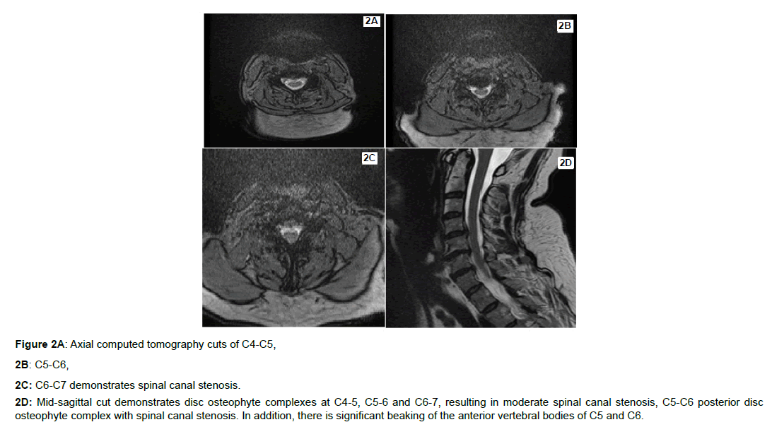 Anterior Osteophytes Cervical Spine