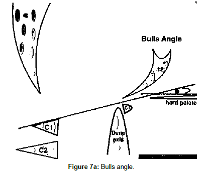 spine-neurosurgery-Bulls-angle