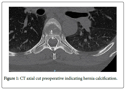 spine-neurosurgery-CT-axial