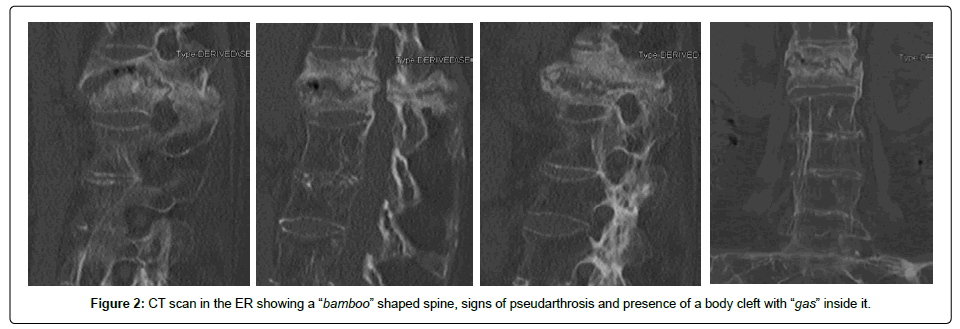 spine-neurosurgery-CT-scan