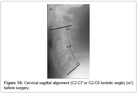 spine-neurosurgery-Cervical-sagittal