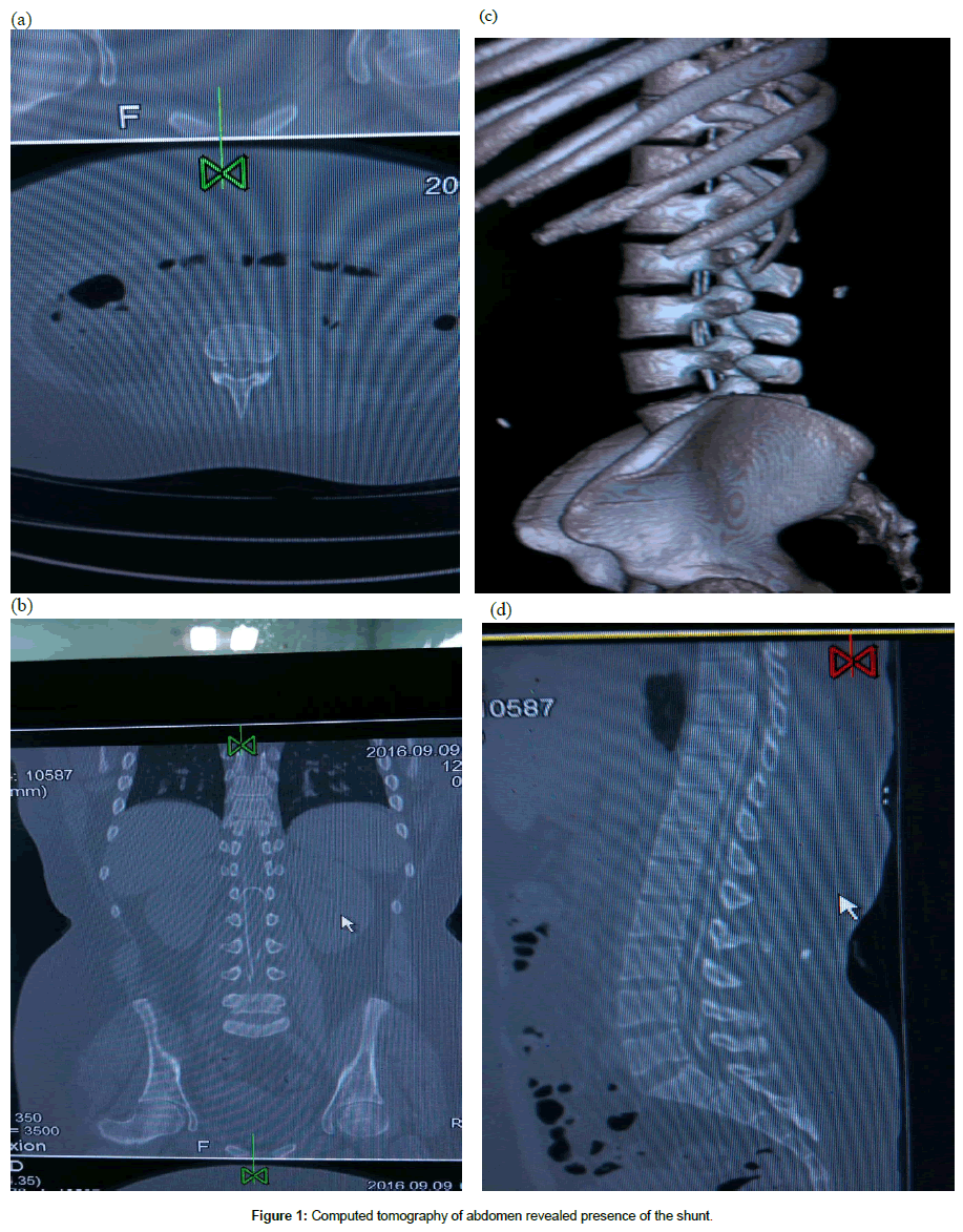spine-neurosurgery-Computed-tomography