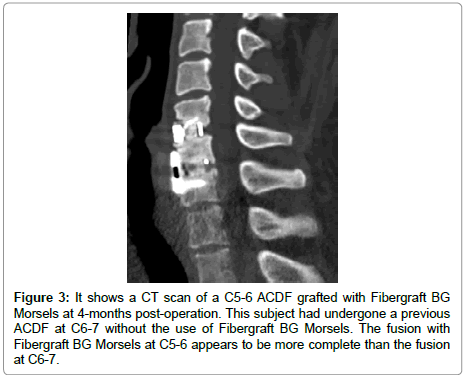 spine-neurosurgery-Fibergraft-BG-Morsels