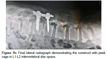 spine-neurosurgery-Final-lateral